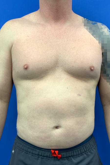 After image 1 Case #129431 - Liposuction