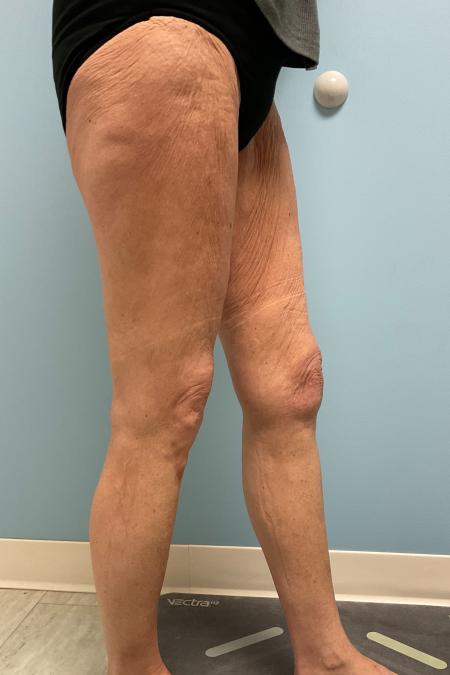 Before image 3 Case #129816 - 68 y.o female with Thigh Lift and Lipo