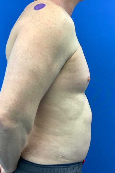 After image 2 Case #129431 - Liposuction