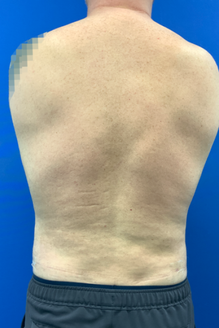 After image 4 Case #129431 - Liposuction