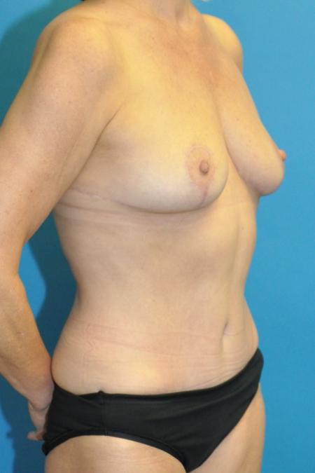 After image 2 Case #130141 - Mommy Makeover