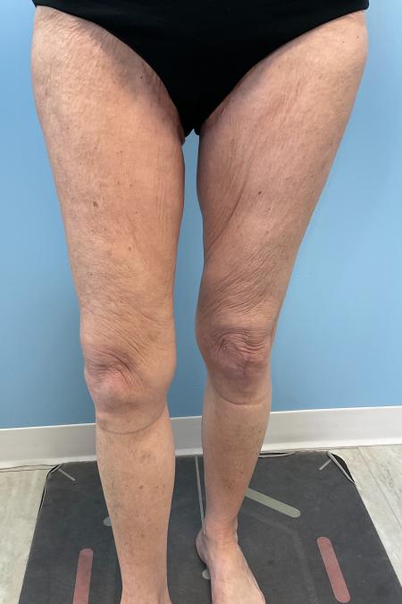 After image 2 Case #129816 - 68 y.o female with Thigh Lift and Lipo