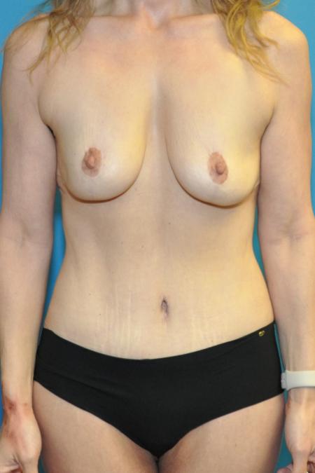 After image 1 Case #130131 - Mommy Makeover
