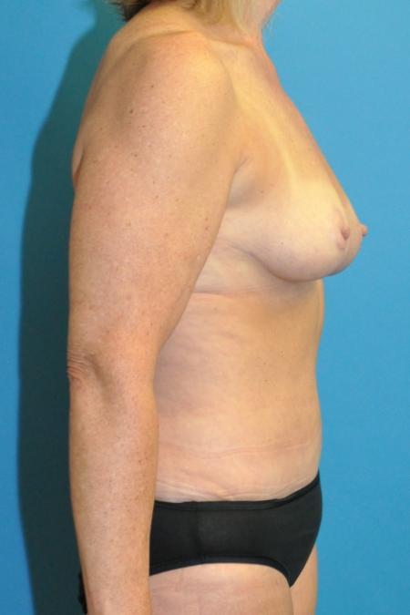After image 3 Case #130151 - Mommy Makeover