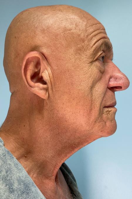 Before image 2 Case #129916 - 64 y.o. male with Face and Necklift