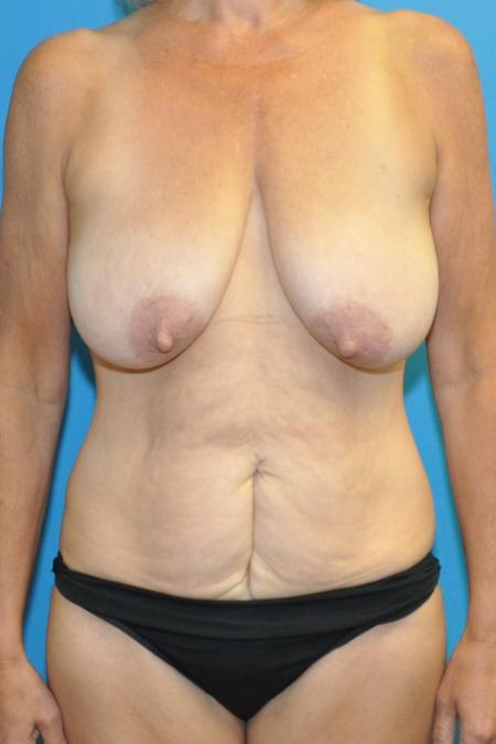 Before image 1 Case #130141 - Mommy Makeover