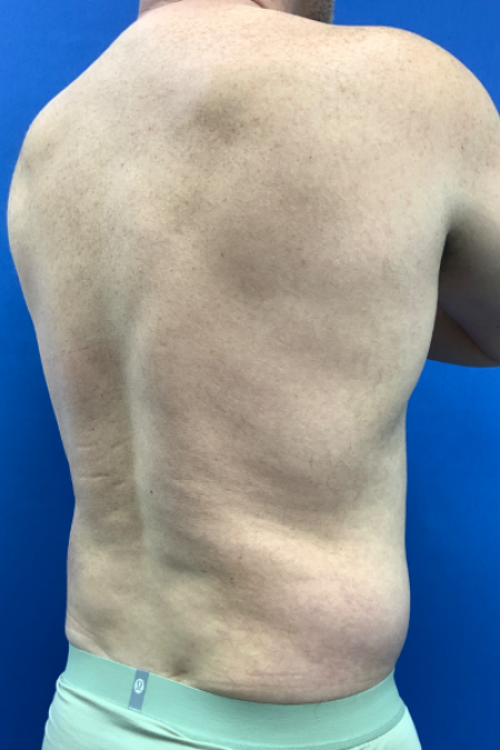 Before image 3 Case #129431 - Liposuction