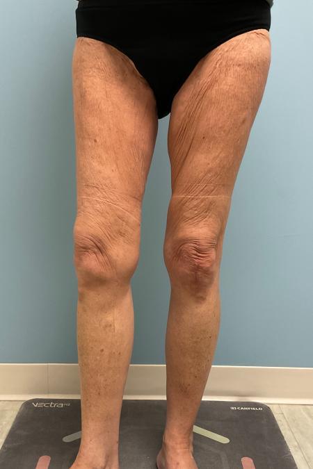 Before image 2 Case #129816 - 68 y.o female with Thigh Lift and Lipo