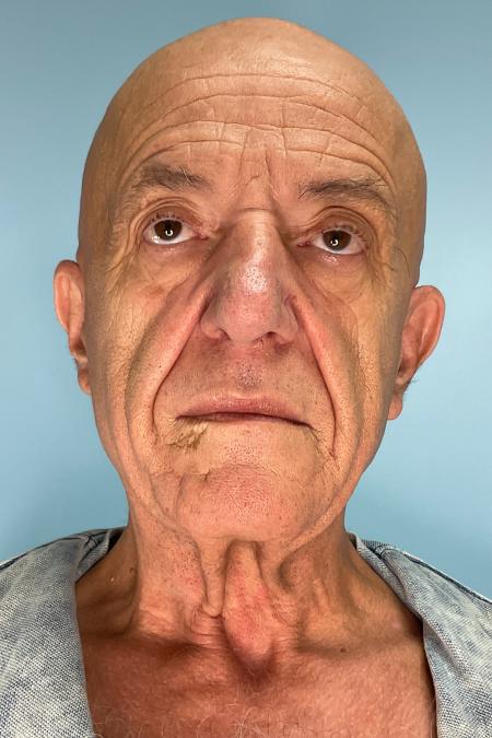 Before image 1 Case #129916 - 64 y.o. male with Face and Necklift