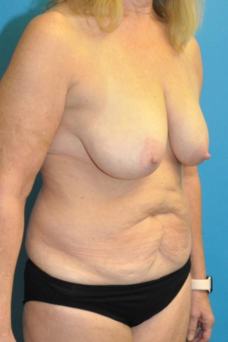 Before image 2 Case #130151 - Mommy Makeover