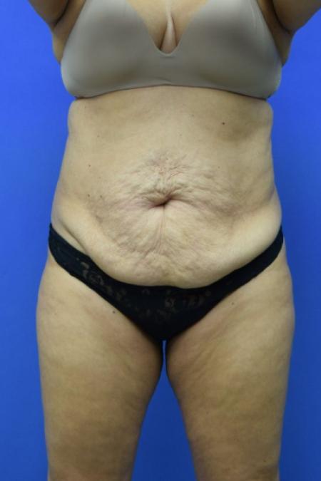 Before image 1 Case #129716 - Tummy tuck with BBL