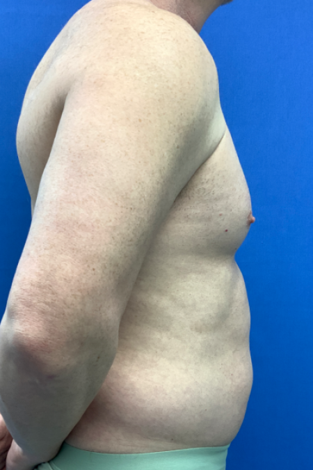 Before image 2 Case #129431 - Liposuction