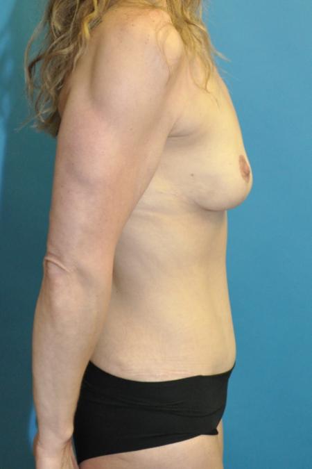 After image 3 Case #130131 - Mommy Makeover