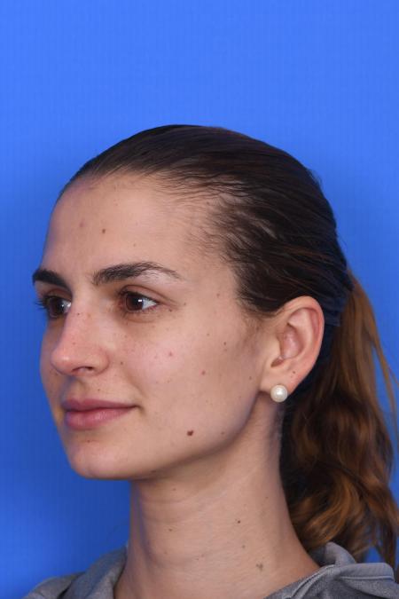 After image 5 Case #129951 - RHINOPLASTY
