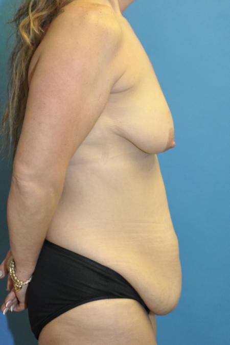 Before image 3 Case #130131 - Mommy Makeover