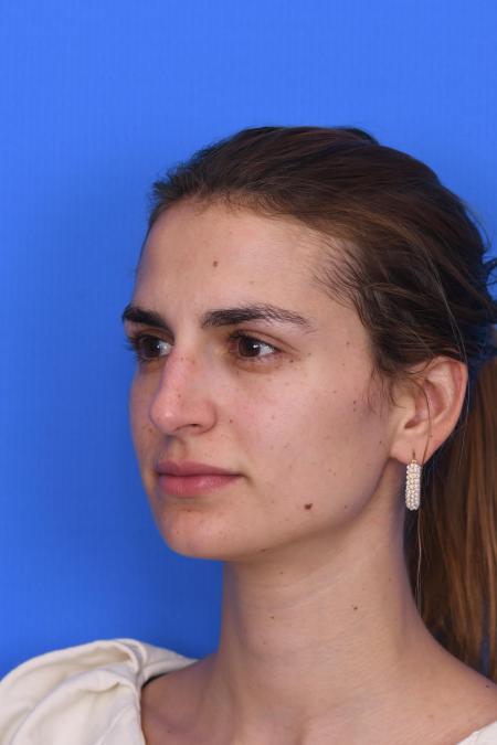 Before image 5 Case #129951 - RHINOPLASTY