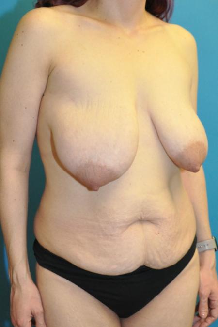 Before image 2 Case #130136 - Mommy Makeover