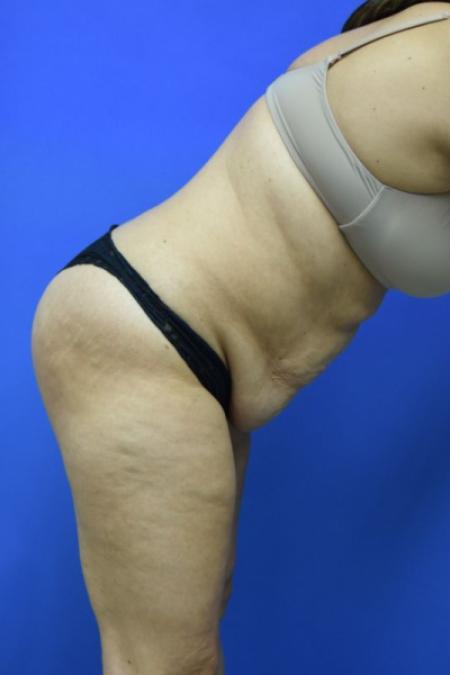 Before image 3 Case #129716 - Tummy tuck with BBL