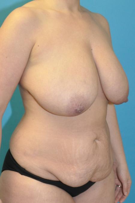 Before image 2 Case #130156 - Mommy Makeover