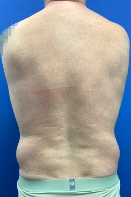 Before image 4 Case #129431 - Liposuction