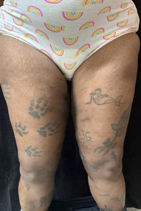 After image 1 Case #130396 - Thigh Lift