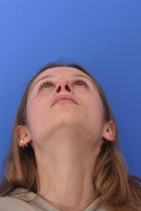 After image 6 Case #130261 - STRUCTURAL RHINOPLASTY