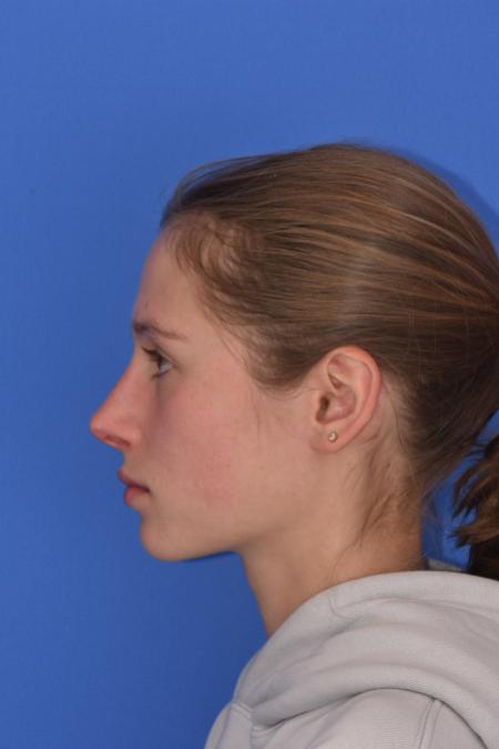 After image 3 Case #130261 - STRUCTURAL RHINOPLASTY