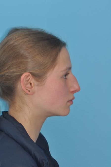 Before image 5 Case #130261 - STRUCTURAL RHINOPLASTY