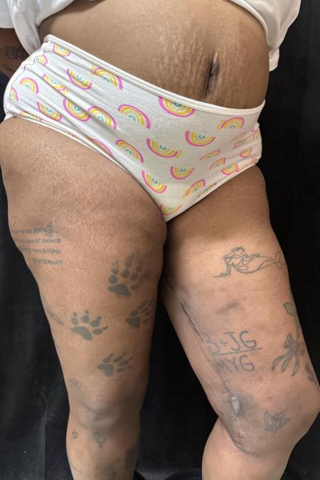 After image 3 Case #130396 - Thigh Lift