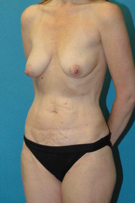 Before image 2 Case #130381 - Mommy Makeover