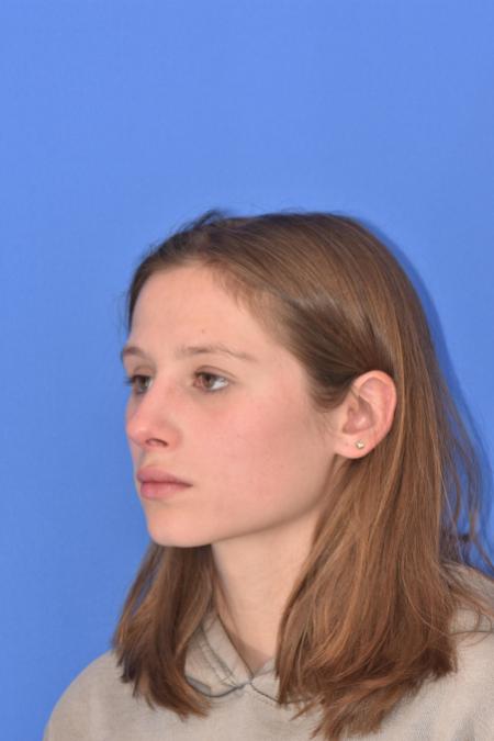 After image 4 Case #130261 - STRUCTURAL RHINOPLASTY