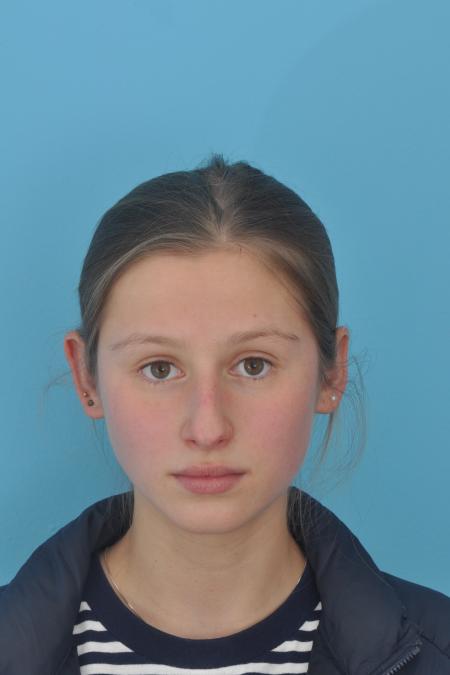 Before image 1 Case #130261 - STRUCTURAL RHINOPLASTY