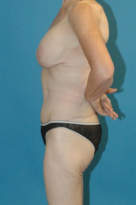 After image 3 Case #130326 - Post Weight Loss Body and Breast Surgery