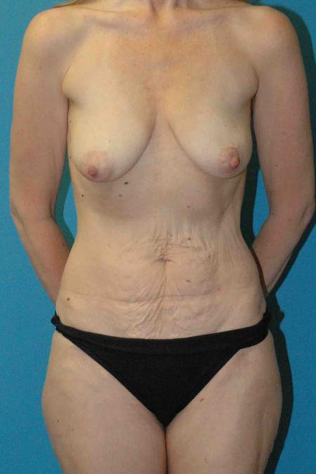 Before image 1 Case #130381 - Mommy Makeover