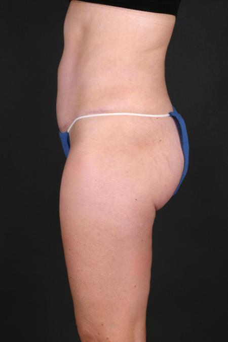 After image 3 Case #130196 - Tummy Tuck