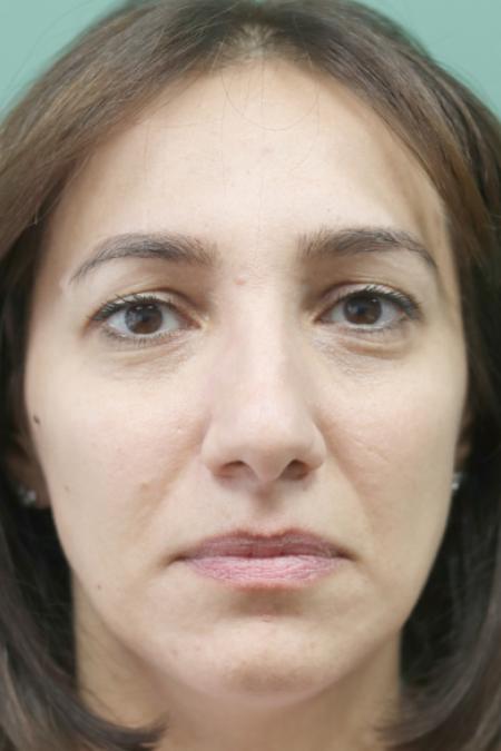 Before image 1 Case #130881 - Conventional Septorhinoplasty
