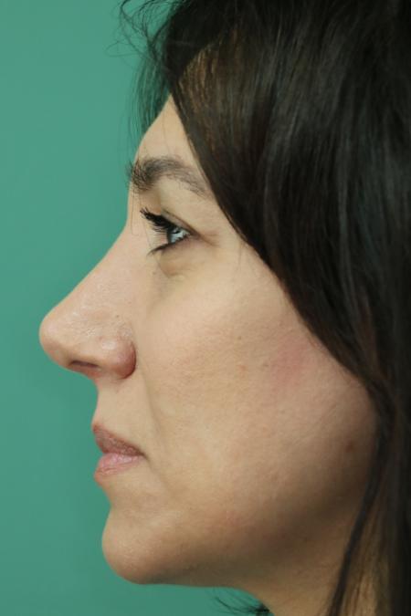 After image 5 Case #130881 - Conventional Septorhinoplasty