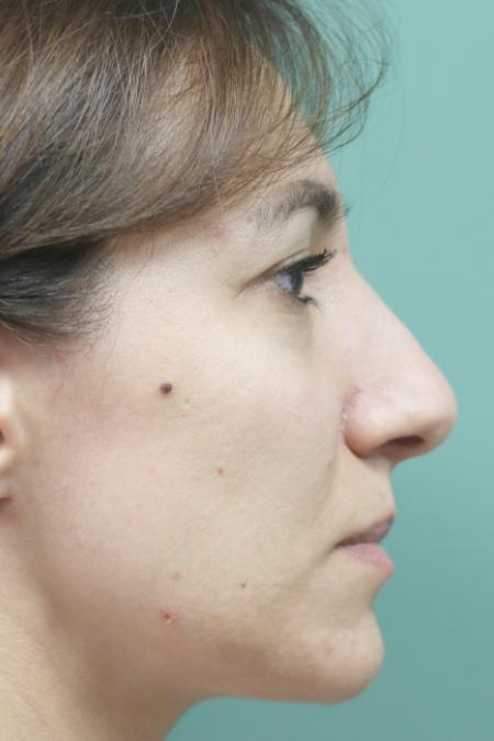 Before image 4 Case #130881 - Conventional Septorhinoplasty