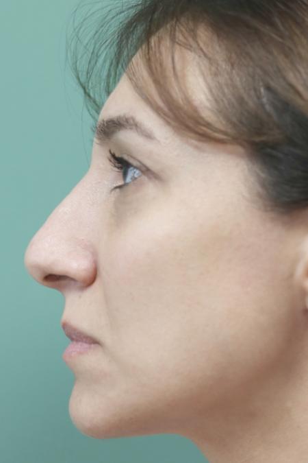 Before image 5 Case #130881 - Conventional Septorhinoplasty