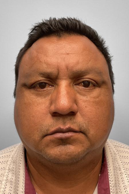 After image 1 Case #132776 - Lower Blepharoplasty