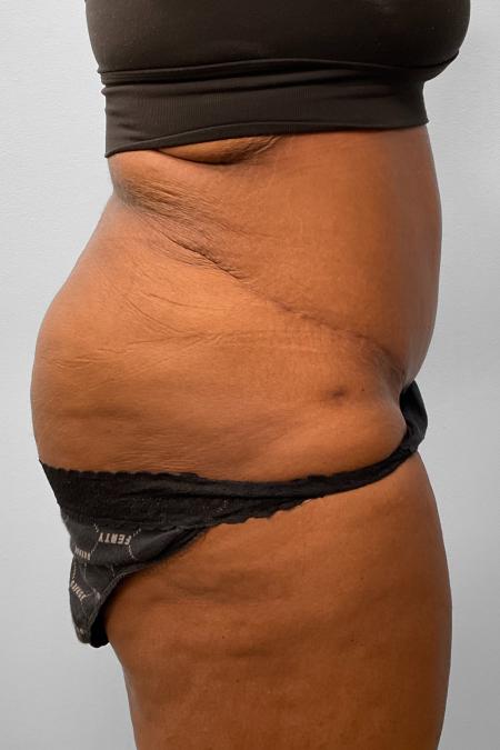 After image 3 Case #132791 - Tummy Tuck