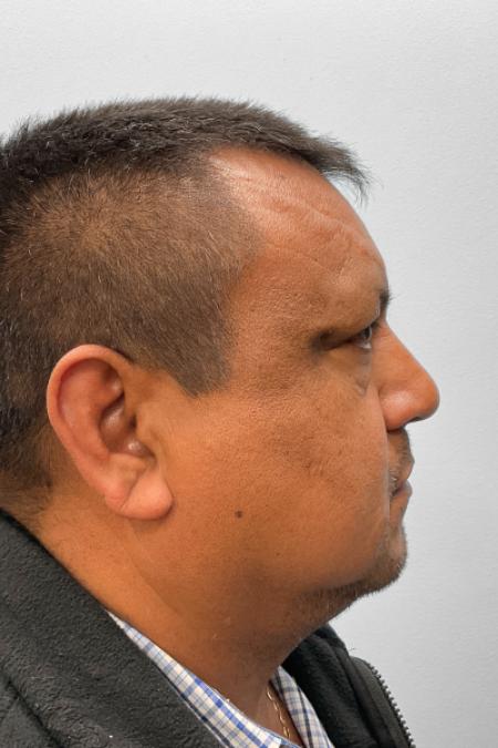Before image 3 Case #132776 - Lower Blepharoplasty