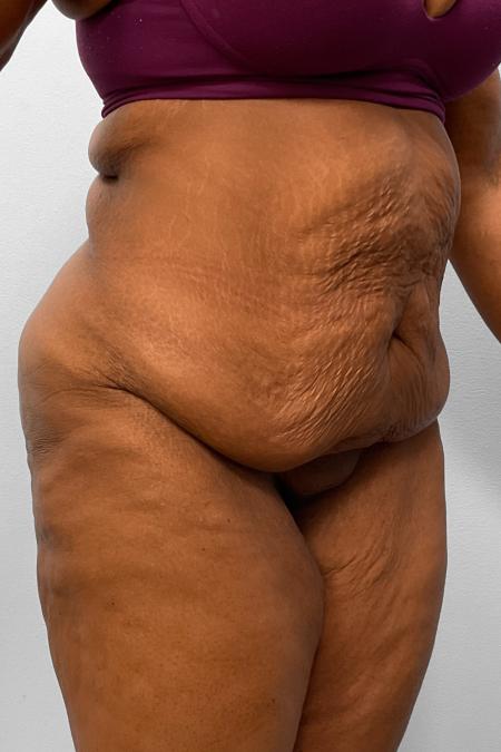 Before image 2 Case #132791 - Tummy Tuck