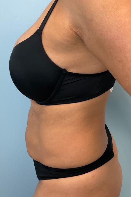Before image 3 Case #133456 - 48 y.o female w/ Mini Tummy Tuck & Lipo