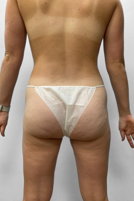 After image 4 Case #133321 - Tummy Tuck