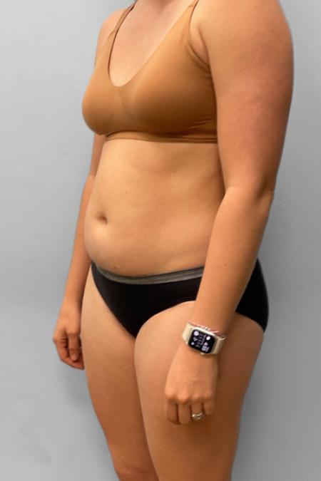 Before image 2 Case #133321 - Tummy Tuck