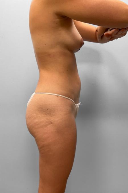 After image 3 Case #133321 - Tummy Tuck