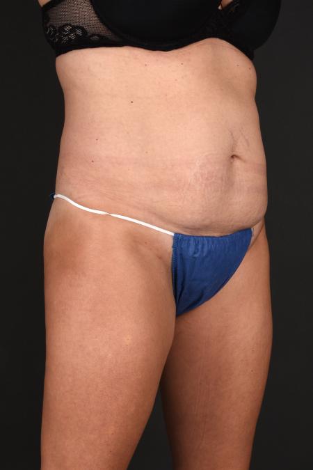 Before image 2 Case #133651 - Abdominoplasty