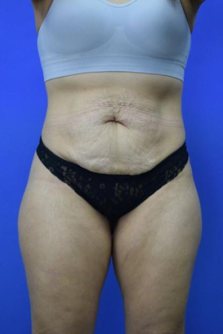 Before image 1 Case #134256 - Drainless Tummy Tuck