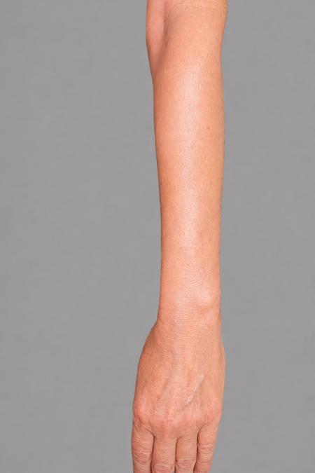 After image 2 Case #133646 - 66 y.o. female with IPL to arms